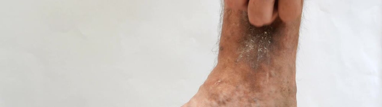 Person experiencing intense itching and scratching skin on their leg indicating symptoms of eczema dermatitis or psoriasis.