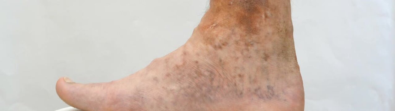 Leg of a person exhibiting symptoms of chronic venous insufficiency including visible varicose veins and hyperpigmentation on the skin.