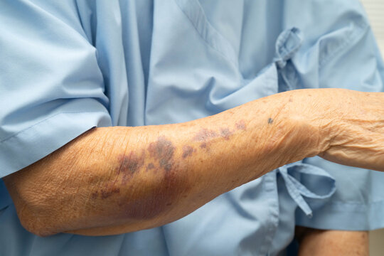 Ecchymosis, elderly bleeding on her arm after taking aspirin.