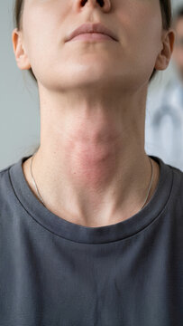 Closeup of a woman with a visible swelling in the neck area, possibly a goiter or thyroid issue