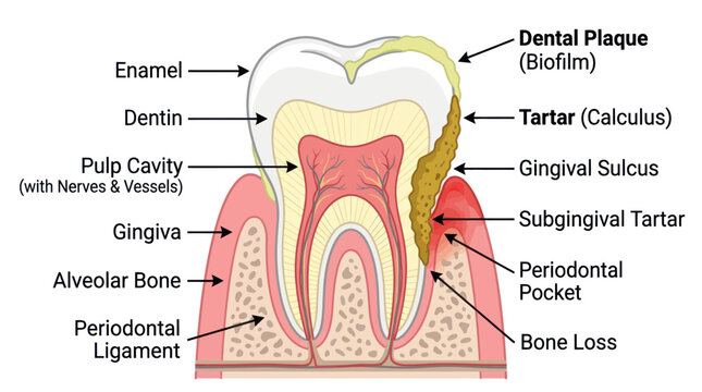Human tooth cross section showing plaque tartar and bone loss