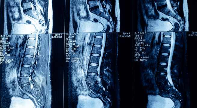 Sagittal lumbar spine mri scans collage with highlighted disc area for medical diagnostic
