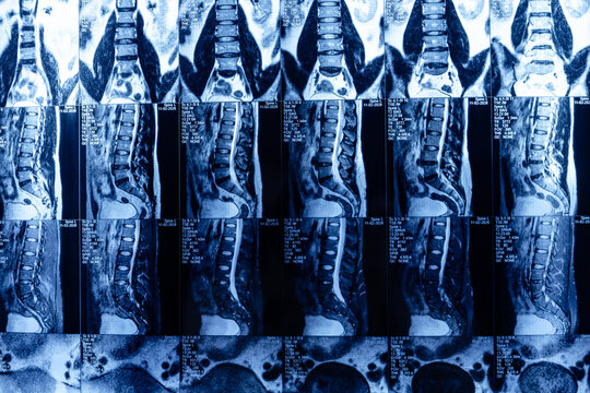 Detailed mri scan of spinal column highlighting disc protrusion