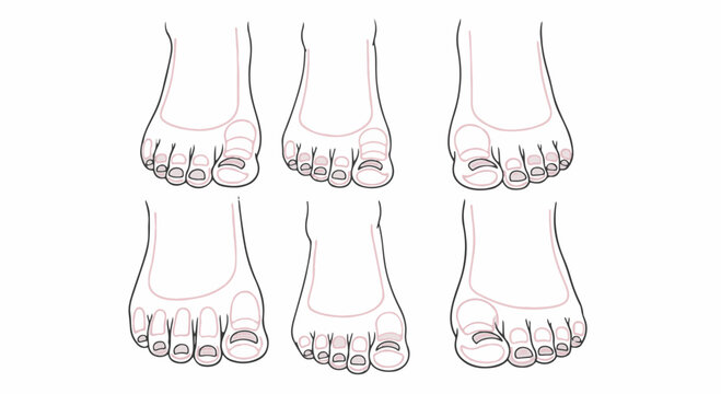 Anatomy line art set displaying six different human foot and toe shape variations, including various lengths and alignments for podiatry or aesthetic reference on white.