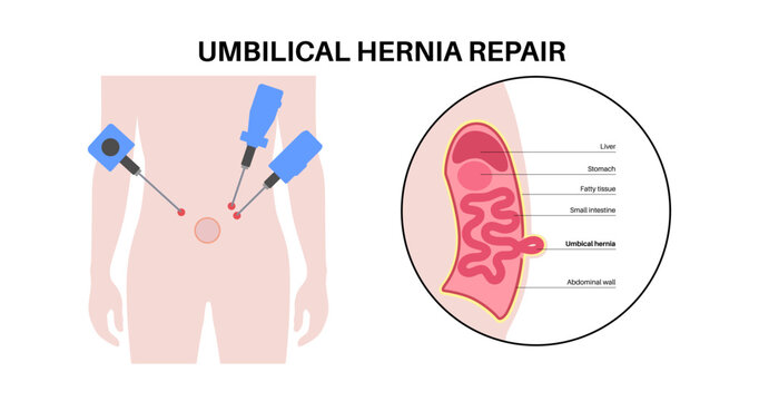 Abdominal Hernia poster