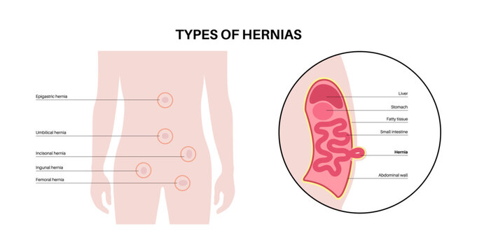 Abdominal Hernia poster