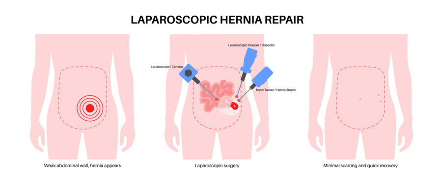 Abdominal Hernia poster