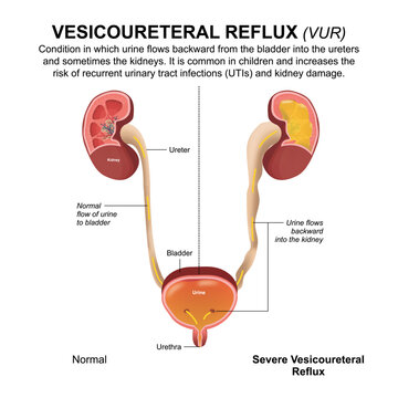 Vesicoureteral Reflux (VUR), Kidney Flashcard Illustration