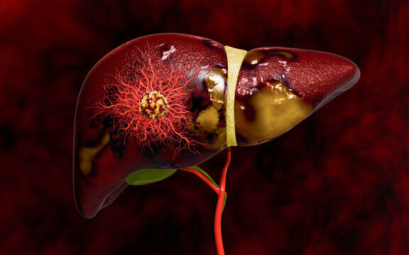 Progression from Healthy Liver to Fatty Liver and Liver Cancer Showing Tumor Growth, Angiogenesis, Cellular Invasion, and Disease Development from Metabolic Disorders 3D Rendering