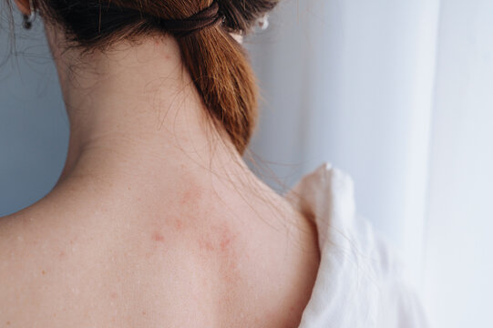Close-up view of woman back with red skin irritation and allergic rash, dermatological disease concept