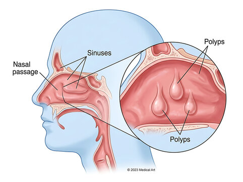 Medical illustration of human head profile showing nasal polyps in sinuses anatomy