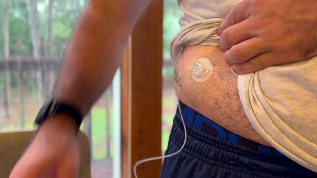 Close-up video of an adult attaching a continuous glucose monitor sensor to the abdomen indoors. Diabetes management, health technology, chronic disease monitoring, and medical device concept.