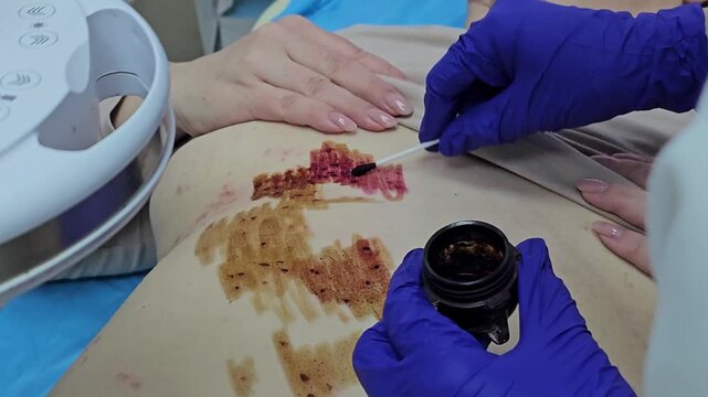 Post procedure skin treatment with antiseptic swab after papilloma and mole removal