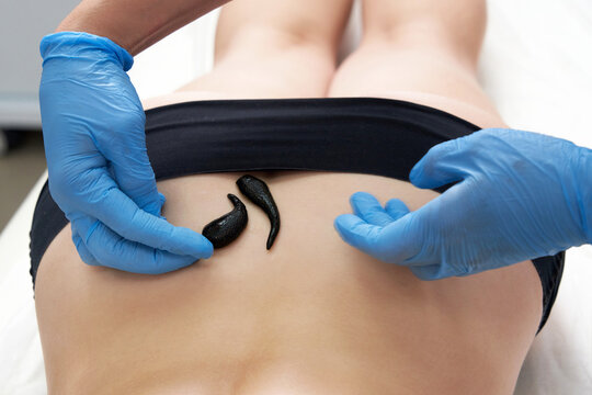 doctor puts the leech, close-up, applying leech it to the patient's skin