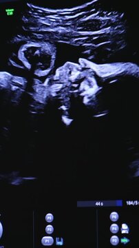 A close up of an ultrasound screen displaying 2d and 3d images of a fetus moving inside mothers womb, pregnant woman undergoing medical examination.