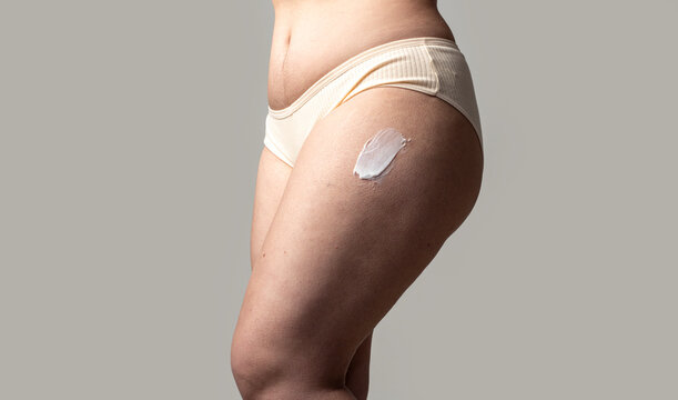 Cellulite on thigh with fat on hips and legs. Cellulite cream on skin for anti cellulite care. Anti cellulite cream on legs with fat.