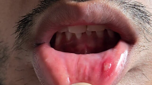 Closeup of a man showing a painful mouth ulcer or canker sore on the inner side of his lower lip
