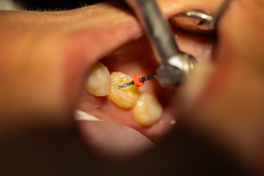 Dentist Performing Root Canal Treatment with Endodontic File