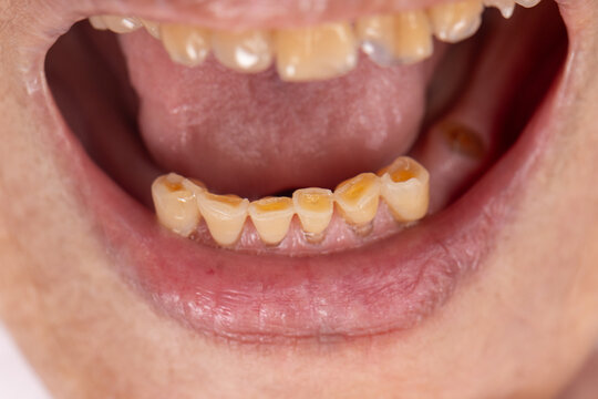 Attrition tooth due to interaction with other teeth in elderly woman.