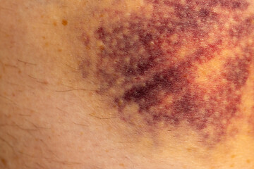 Fototapeta premium Purple hematoma on human skin, internal bleeding
