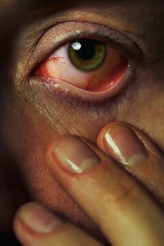 Close-up of a bloodshot eye with visible red blood vessels