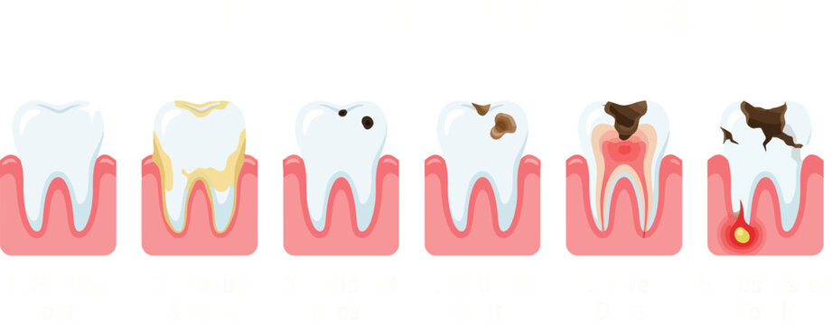 Educational medical vector chart demonstrating cross section anatomy of progressive tooth decay