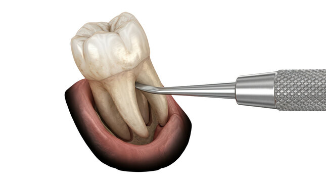 Dental extraction procedure dentist office medical illustration clinical environment close-up view tooth removal techniques