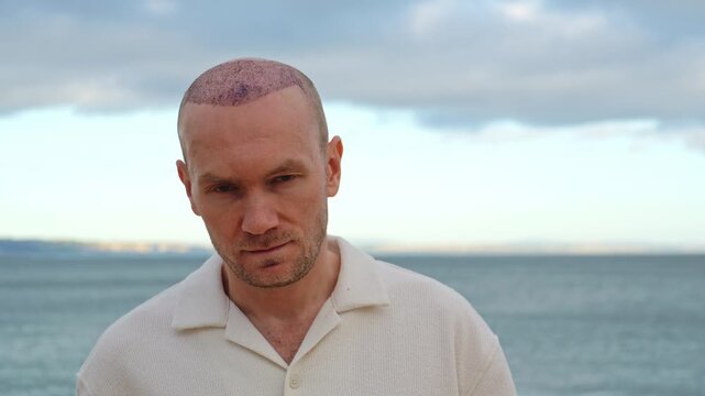 A frontal portrait of a serious and calm Caucasian man showing healing scabs on his scalp after a hair transplant operation, standing outdoors on the coast with an overcast sea view