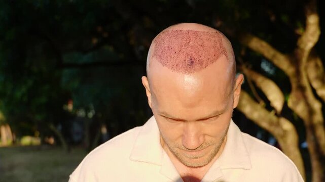 A close-up portrait of a serious and calm Caucasian man showing healing scabs after a recent hair transplant procedure, standing in a park setting under golden sunset sunlight