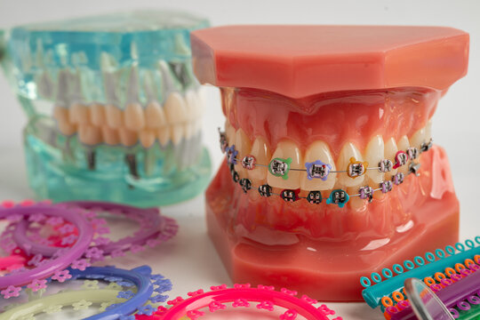 Orthodontic ligatures rings and ties, elastic rubber bands on orthodontic braces, model for dentist studying about dentistry.