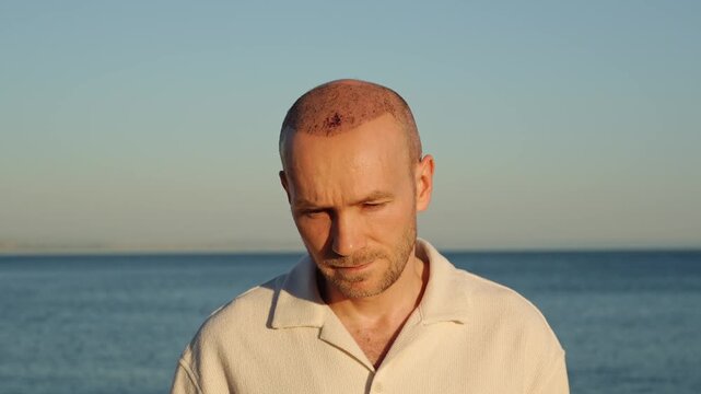 A portrait of a calm and content Caucasian man in a white polo shirt, showing a healing scalp with visible scabs after a recent hair transplant procedure, standing against the sunset ocean