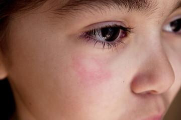 Fototapeta premium Close-up portrait of a little girl with a red insect bite on her cheek under the eye, representing summer allergies, mosquito bites, and skin irritation in children.