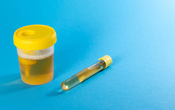 Transport tube with urine and culture reagent, blue background. Urine testing for infections causing urethritis and cystitis. Copy space for text