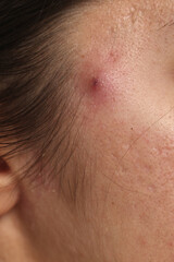 Fototapeta premium Extreme close up of inflamed acne pimple with irritated skin, deep pores and skin texture on woman face.