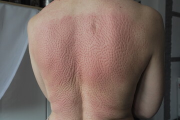 Naklejka premium Human skin with red pressure marks on back after lying on acupressure massage mat