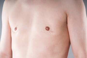 Naklejka premium Male torso with surgical scars after gynecomastia, breast reduction or FTM top surgery, medical and transgender healthcare concept