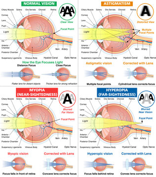 Human eye anatomy and vision disorders infographic poster. Eye focusing and refractive errors. Myopia, hyperopia and astigmatism defects with light focus and corrective lens schemes. Vector