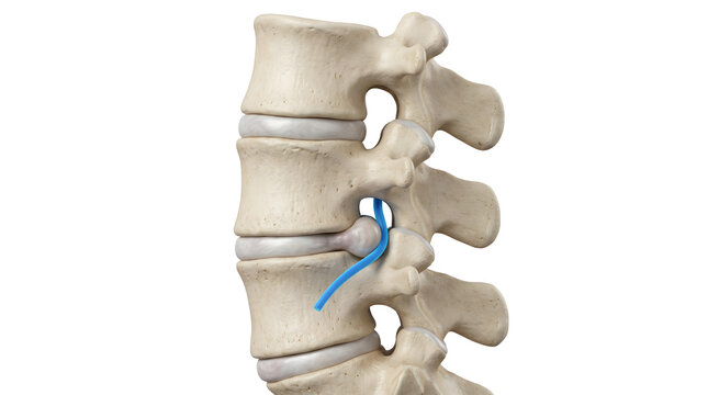 Herniated disc compressing spinal nerve root, lateral view. Lumbar spine anatomy diagram, sciatica or back pain concept. Isolated on white. AI generated.
