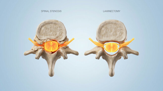 Spinal Stenosis and Laminectomy Surgical Procedure Diagram
