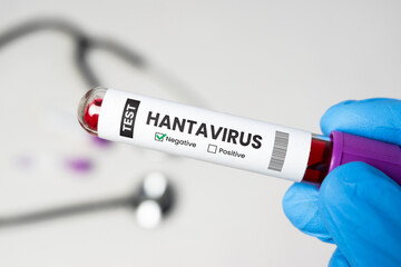 Obraz premium Close-up of a blood sample tube showing a negative hantavirus test result. Infectious disease diagnosis and laboratory testing concept.