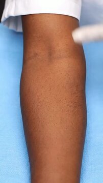 Close-Up Examination of Skin Texture on Human Forearm by Healthcare Professional in Clinical Setting Highlighting Dermatological Assessment