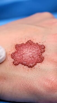 Detailed Realistic Depiction of Squamous Cell Carcinoma on Human Hand Showcasing Abnormal Skin Texture and Color Changes in Clinical Observation