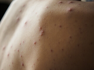 Fototapeta premium Horizontal close up of chickenpox skin rash on child shoulder and back, medical shot of contagious virus infection with itchy red spots, pimples and varicella blisters on patient.