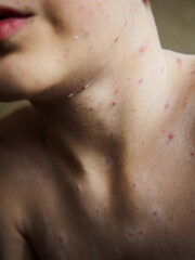 Fototapeta premium Vertical close up of chickenpox skin rash on child neck and chin, medical shot of contagious virus infection with itchy red spots, pimples and varicella blisters on little patient body.