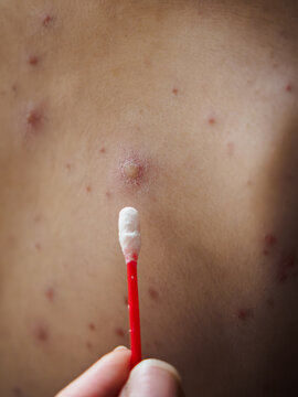 Vertical shot of cotton bud near inflamed skin blister caused by chickenpox virus, macro of medical treatment for contagious varicella rash, red itchy spots and pimples on patient body.