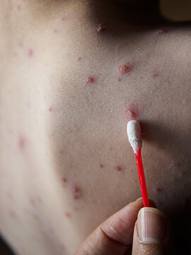 Vertical view of treating multiple chickenpox spots on back skin with cotton bud, medical skin care for viral rash, relieving itch and healing red varicella blisters on infected person body.