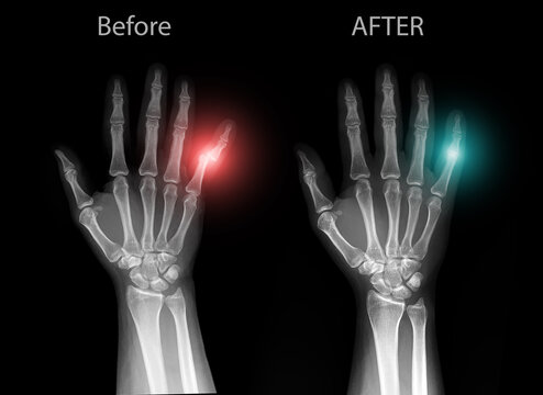 X-ray of human hand showing dislocation of the little finger (fifth finger), AP view on black background. Medical radiograph of bones, joints, metacarpals and phalanges for radiology.