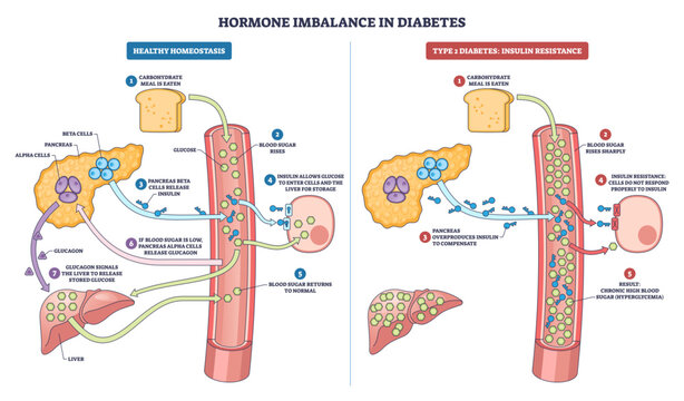Hormone imbalance in diabetes shown as side-by-side schema of normal vs insulin resistance, highlighting pancreas, blood vessel, and liver regulating glucose and insulin, transparent background.