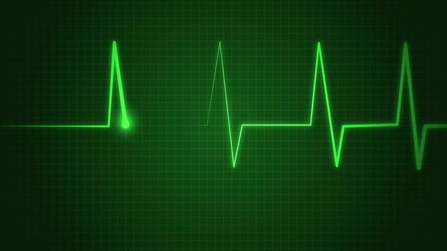 Ecg heart rhythm line on graph paper showing pulse spikes and flat line animation