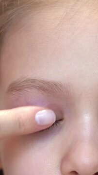 Close up of puffy child eye with barley. Swelling eyelid. Conjunctivitis. Allergy. Medicine and health care. Vertical shot